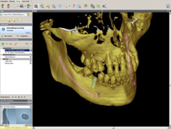 3D-Darstellung eine Implantatplanung